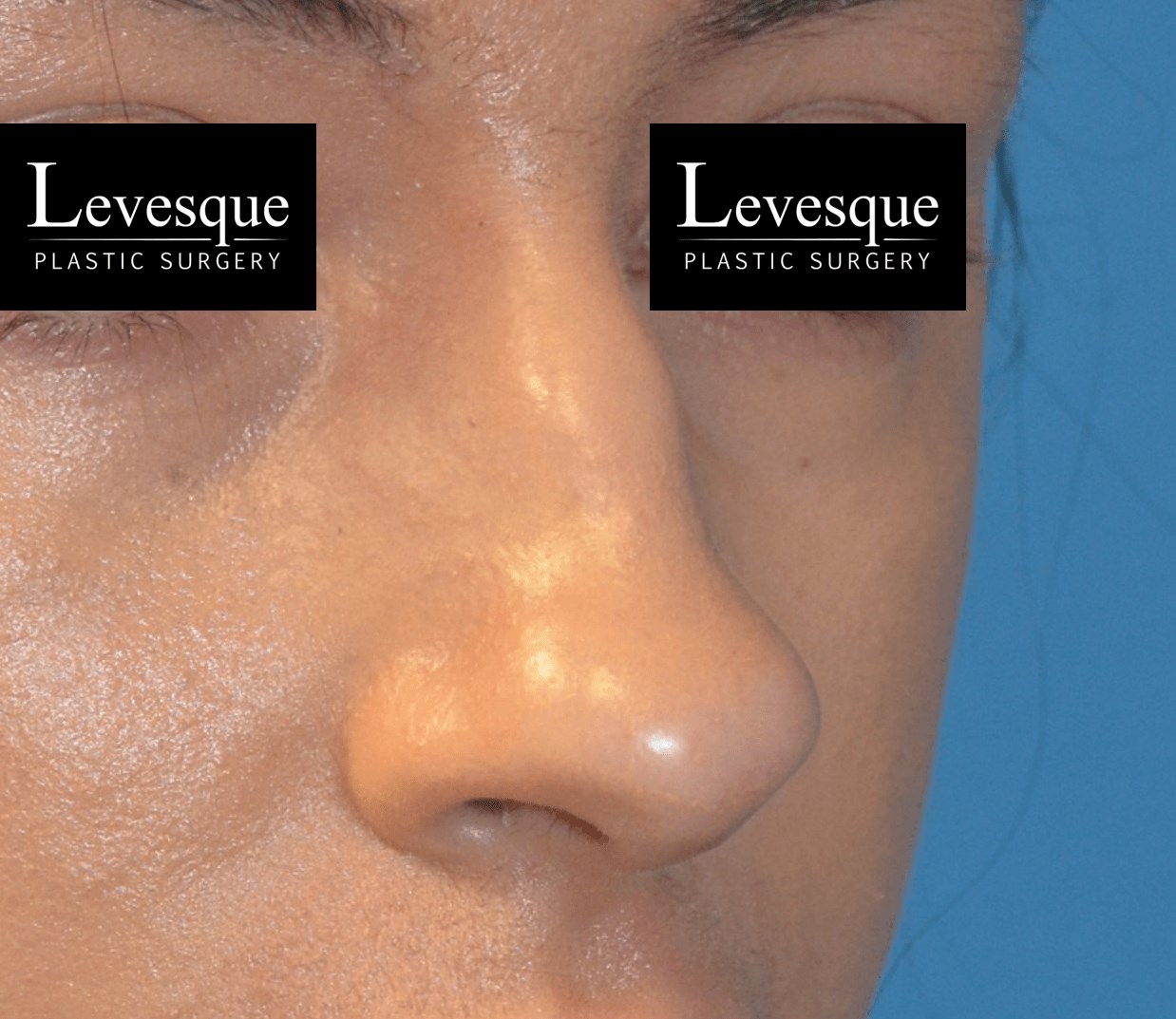 Open Rhinoplasty Before