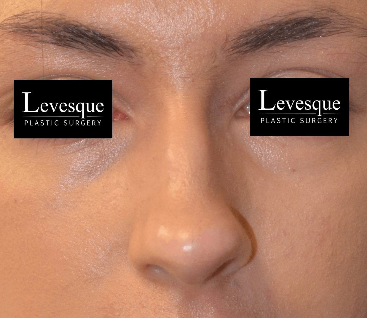 Open Rhinoplasty Before