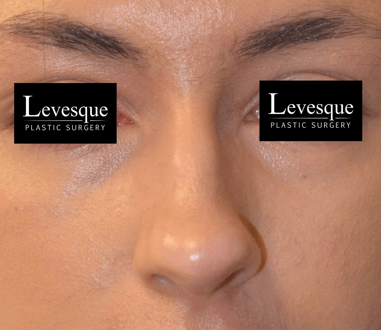 Open Rhinoplasty Before