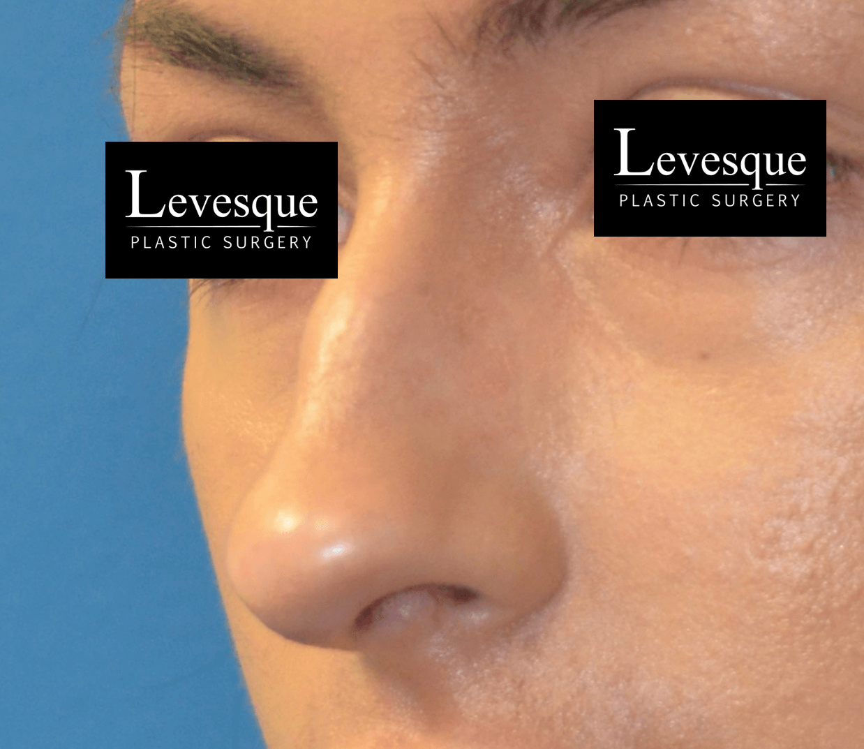 Open Rhinoplasty Before
