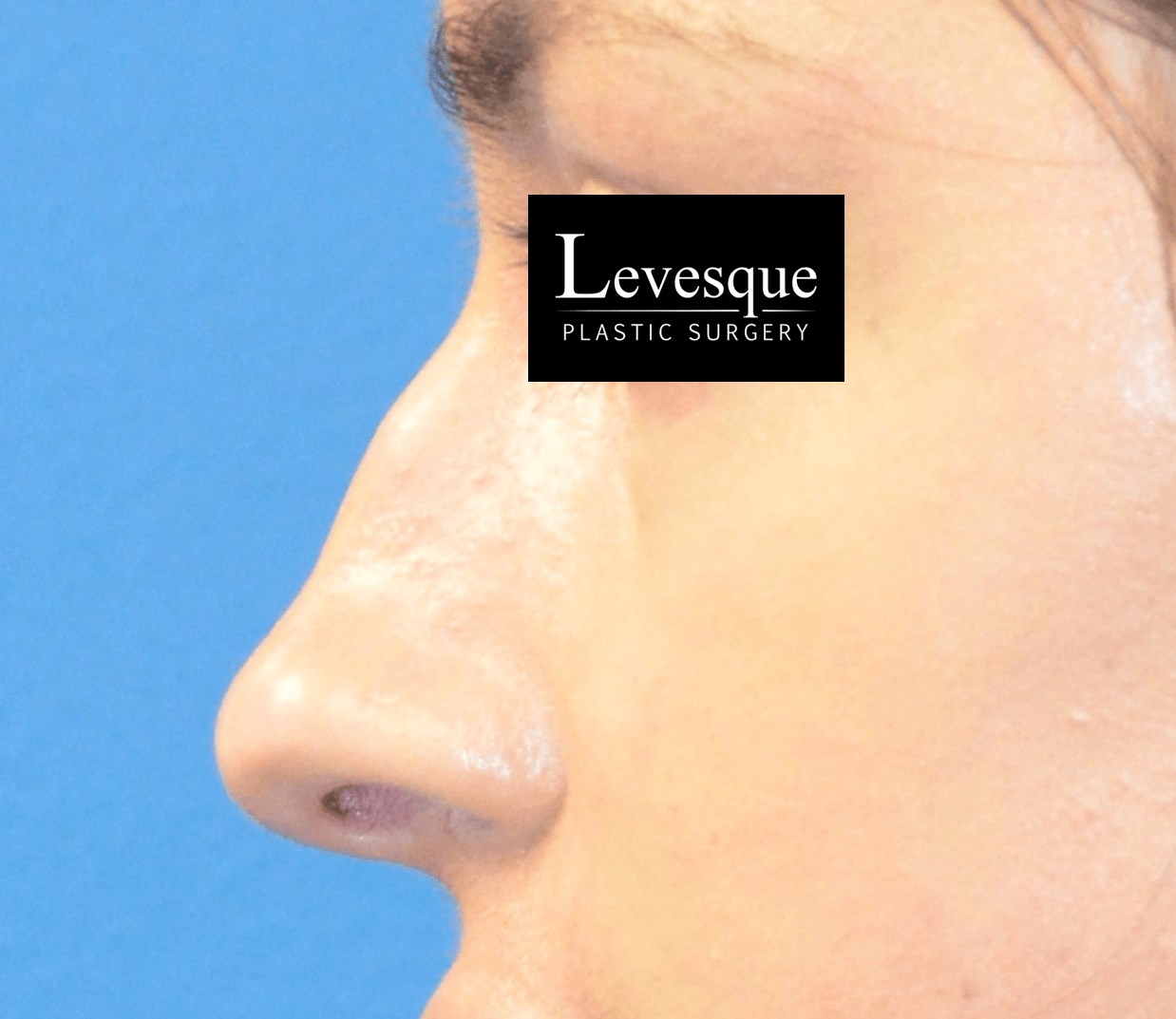 Open Rhinoplasty Before
