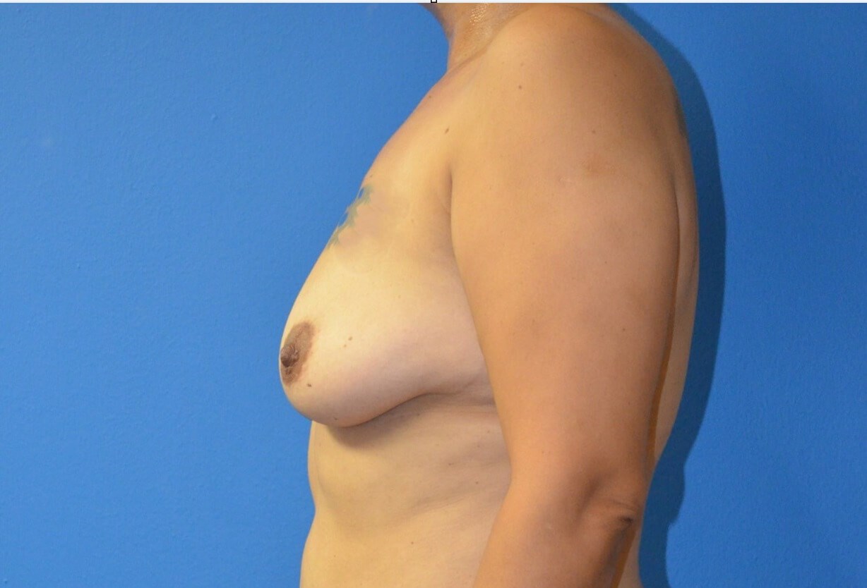 Breast Augmentation 510 cc mod Before