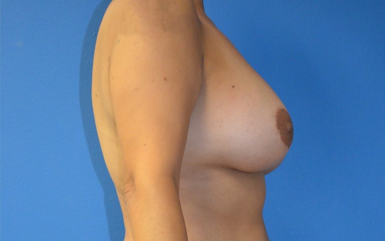 Breast Augmentation 510 cc mod After