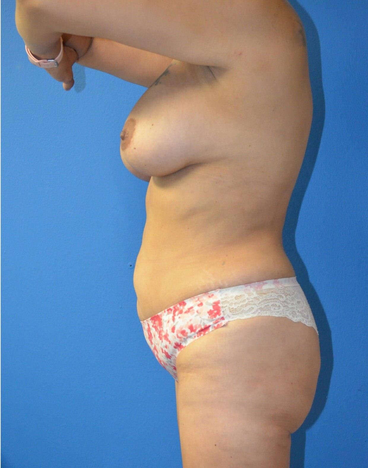 BBL, Renuvion, Lipo 360, BAM After
