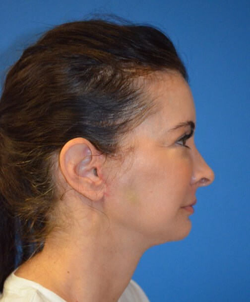 Deep plane face and necklift After