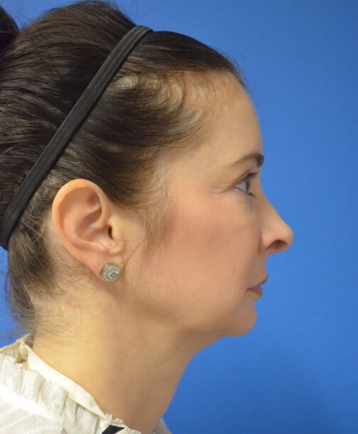 Deep plane face and necklift Before
