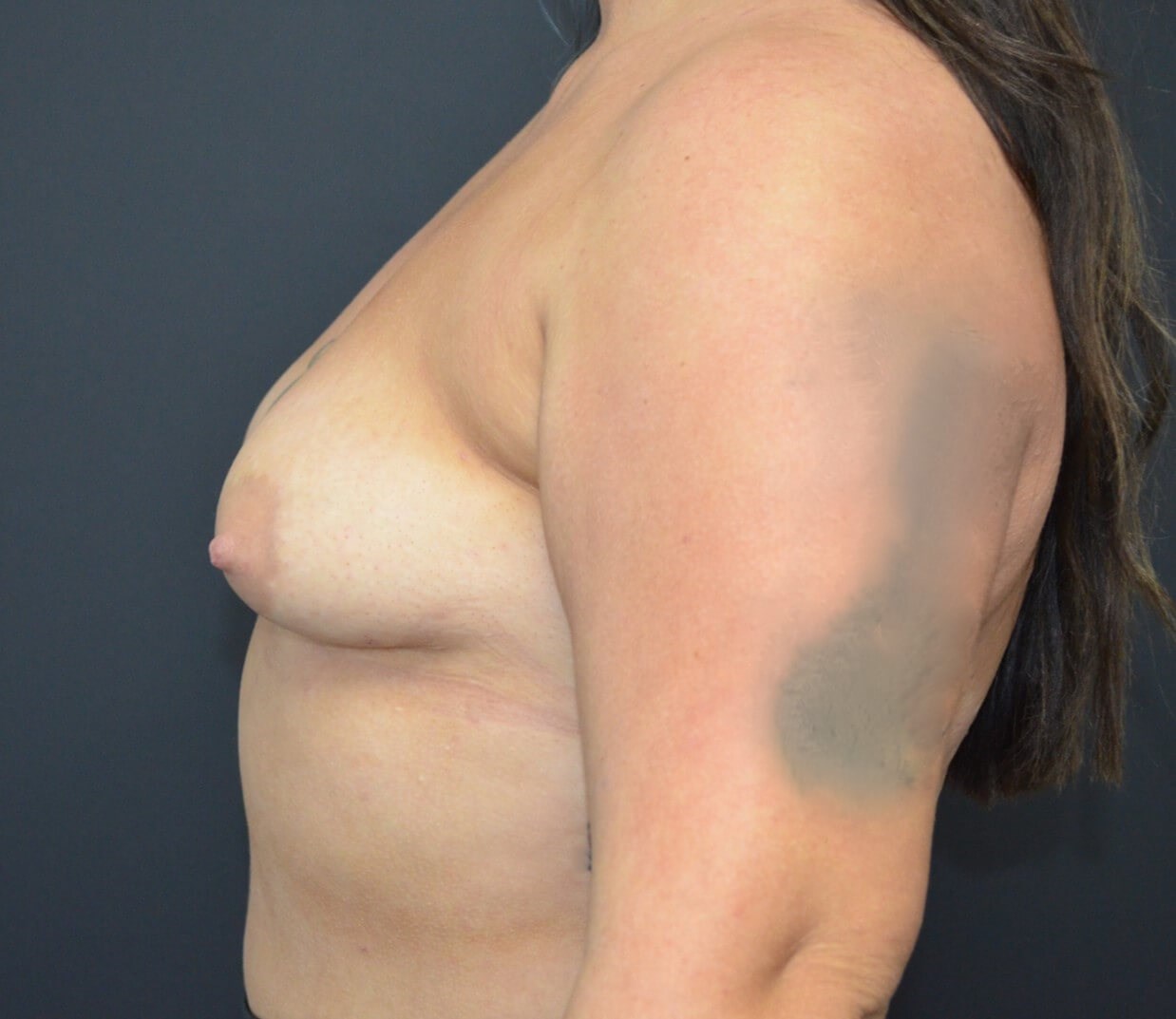 Breast Augmentation 630 cc mod Before