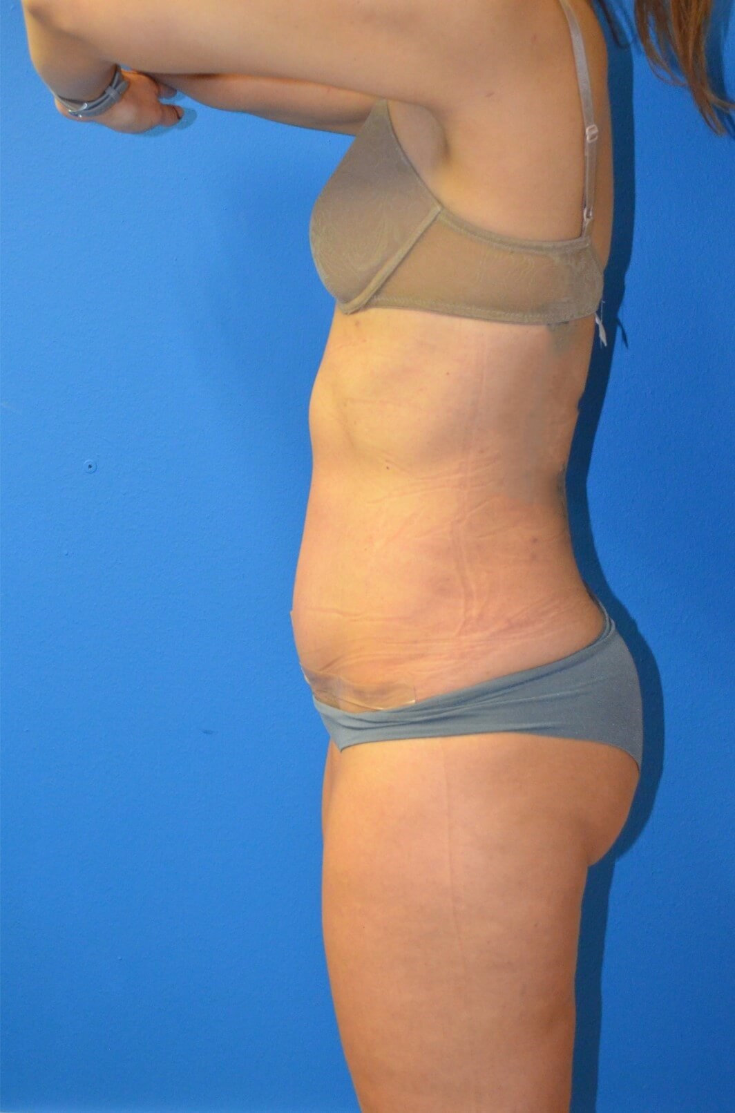 Lipoabdominoplasty, Lipo360 After
