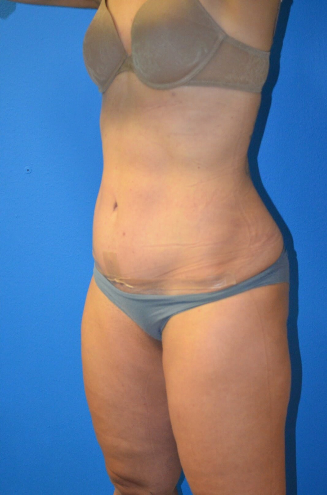 Lipoabdominoplasty, Lipo360 After