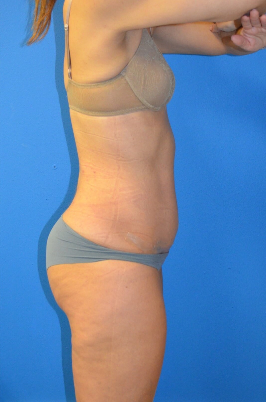 Lipoabdominoplasty, Lipo360 After