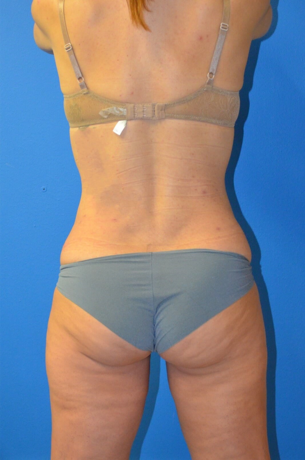 Lipoabdominoplasty, Lipo360 After