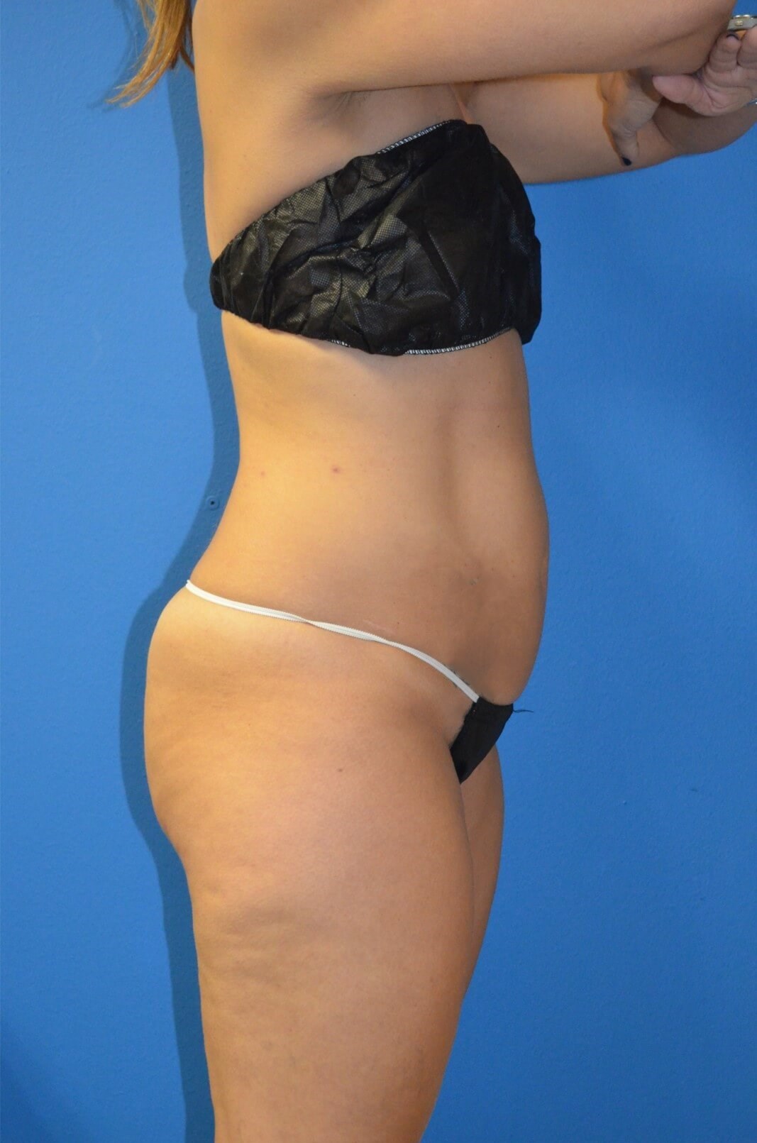 Lipoabdominoplasty, Lipo360 Before