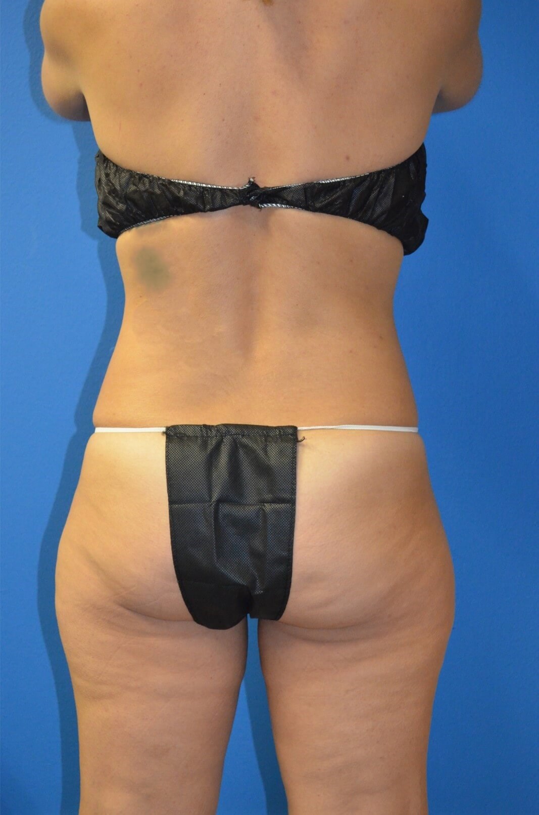 Lipoabdominoplasty, Lipo360 Before