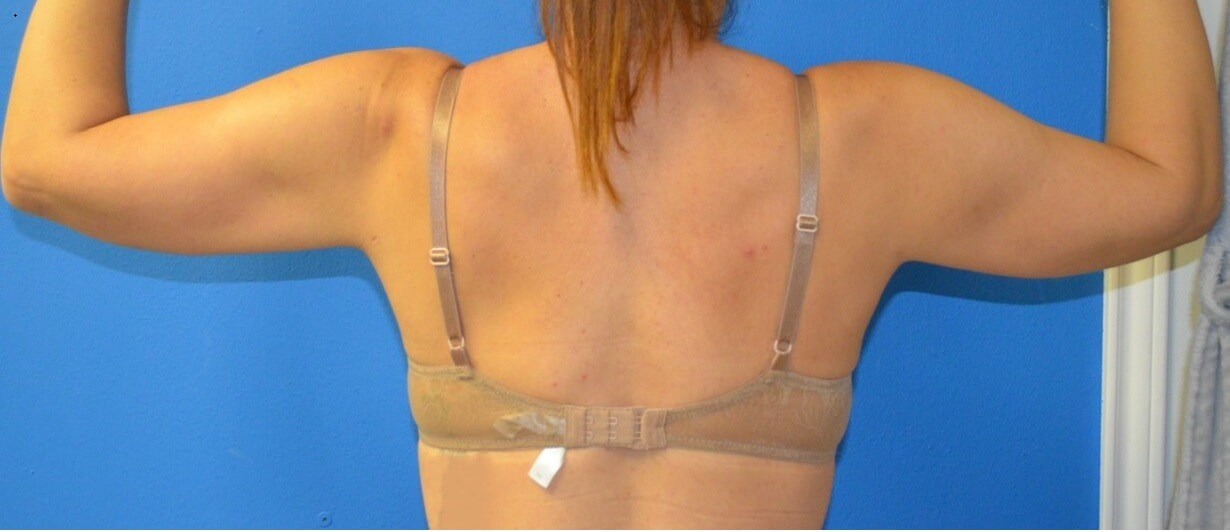 Vaser liposculpture arms After