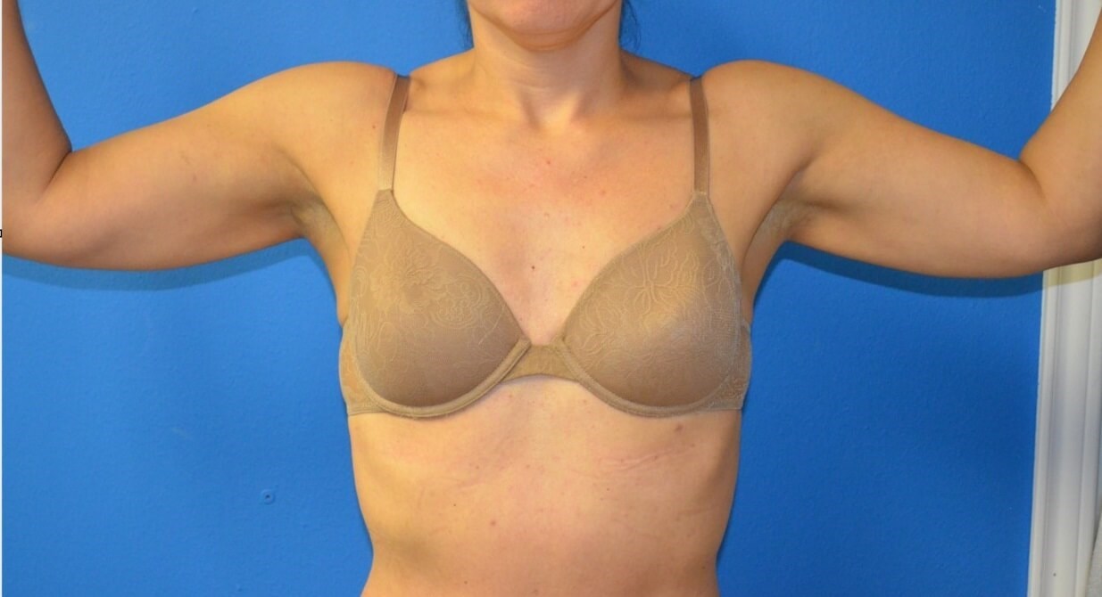 Vaser liposculpture arms After