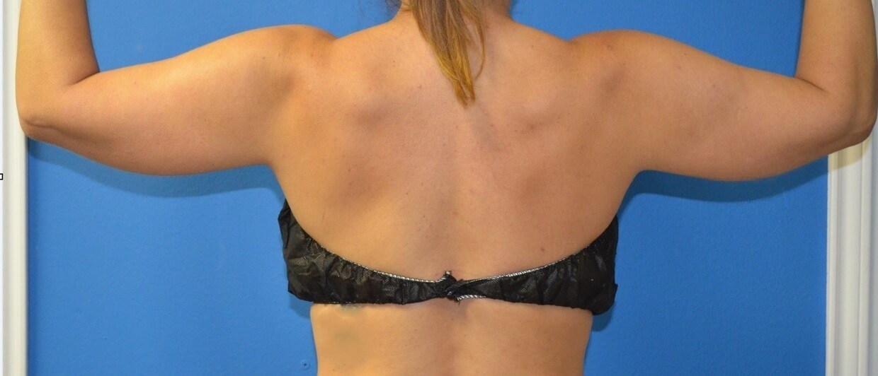 Vaser liposculpture arms Before