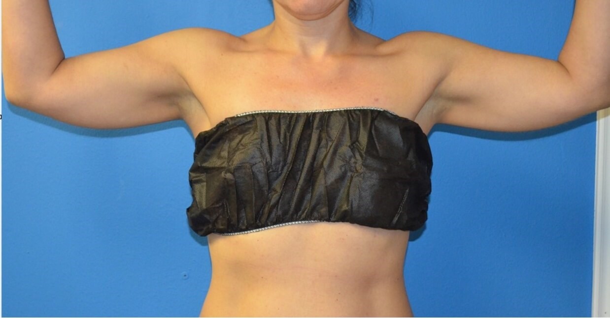 Vaser liposculpture arms Before