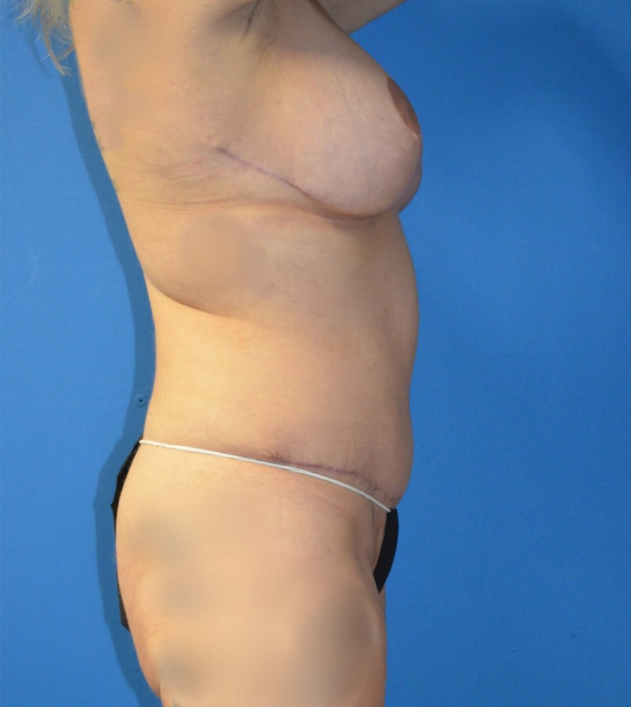Lipoabdominoplasty, Breast Aug After
