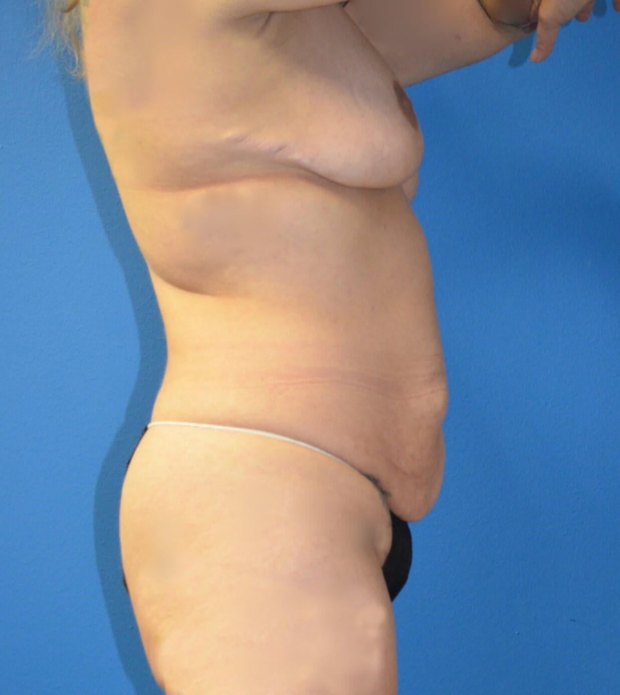 Lipoabdominoplasty, Breast Aug Before