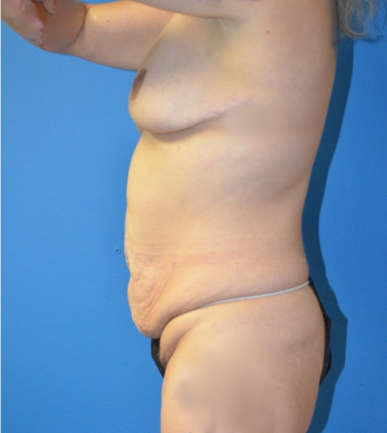 Lipoabdominoplasty, Breast Aug Before