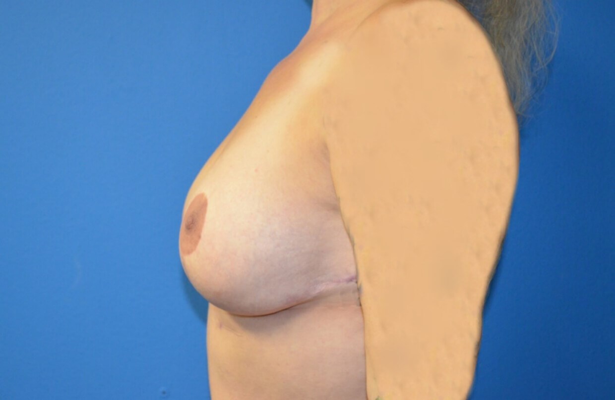 Augmentation after a reduction After