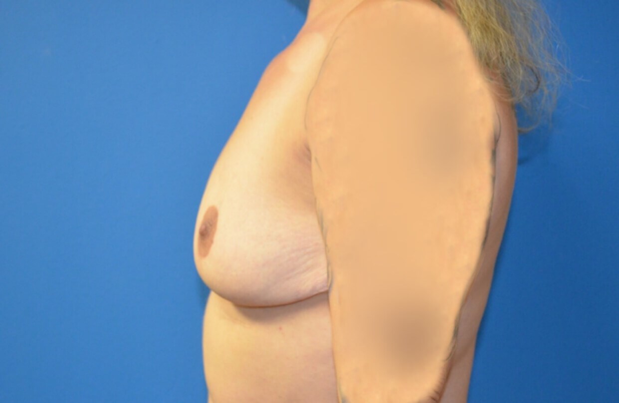 Augmentation after a reduction Before