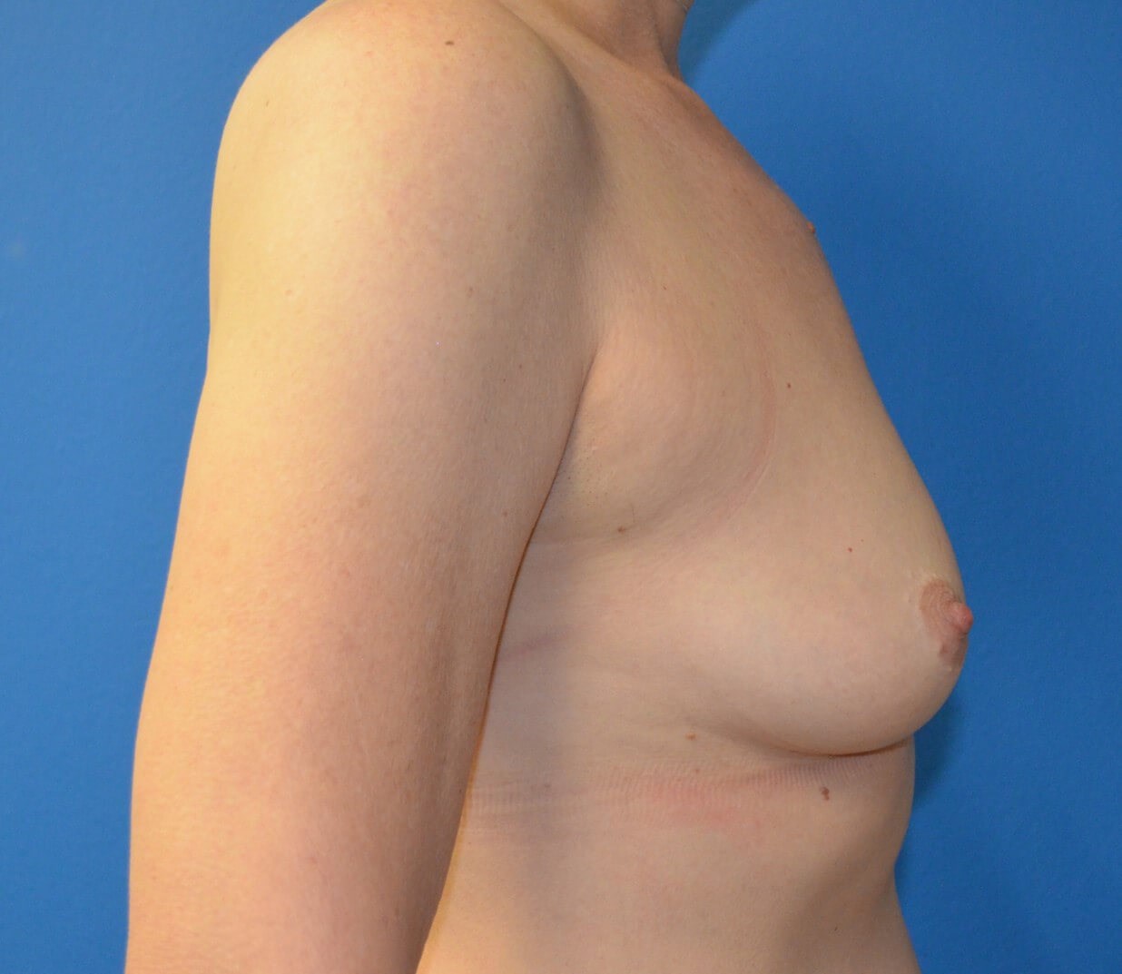Breast Augmentation 425 cc mod Before