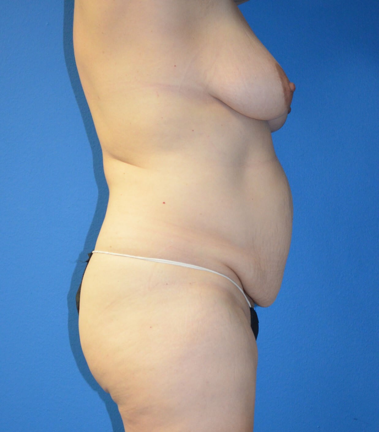 Tummy Tuck Breast Lift Lipo360 Before
