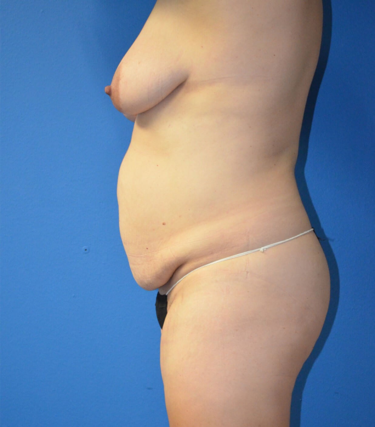 Tummy Tuck Breast Lift Lipo360 Before
