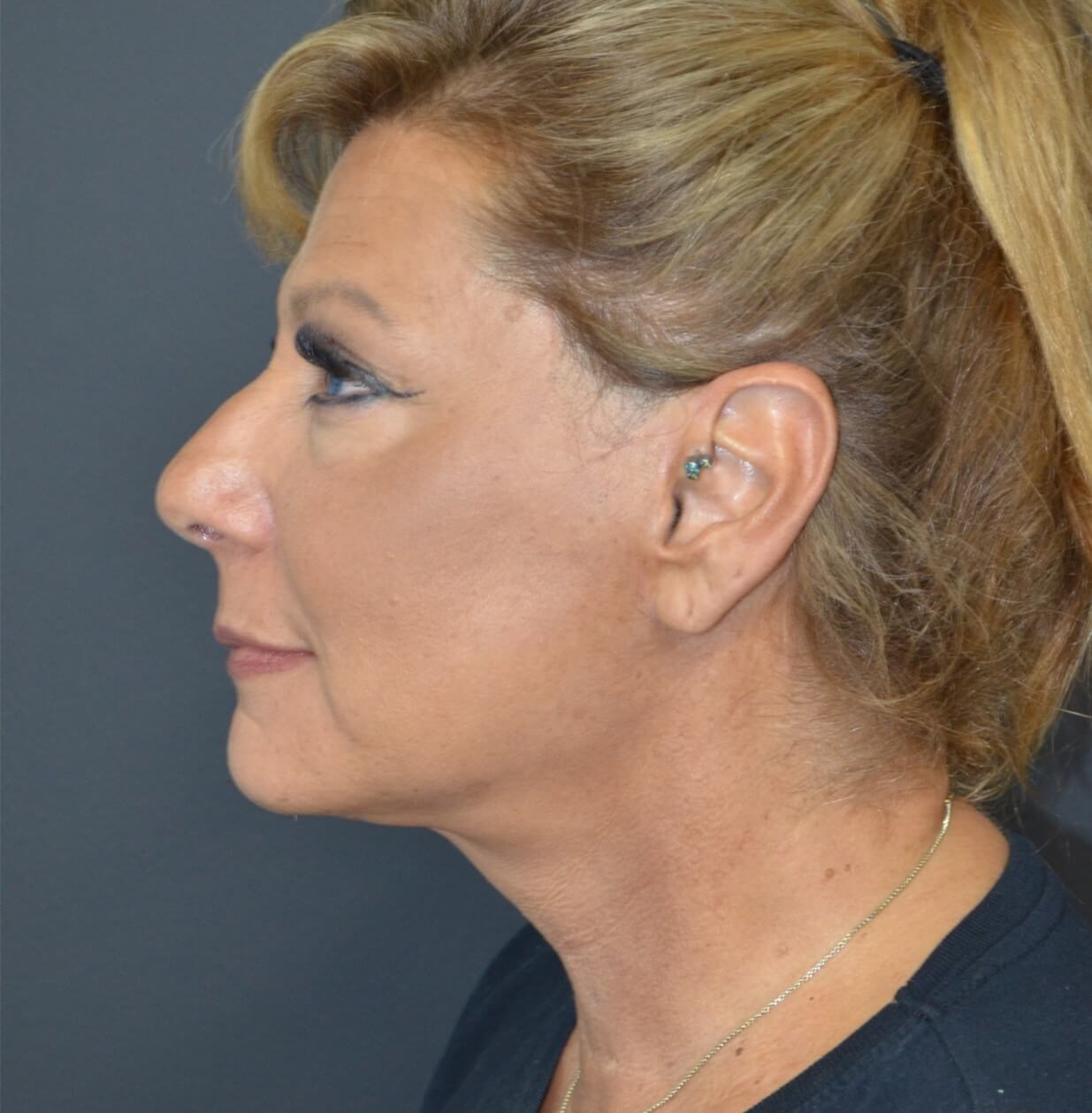 Deep plane face and necklift After