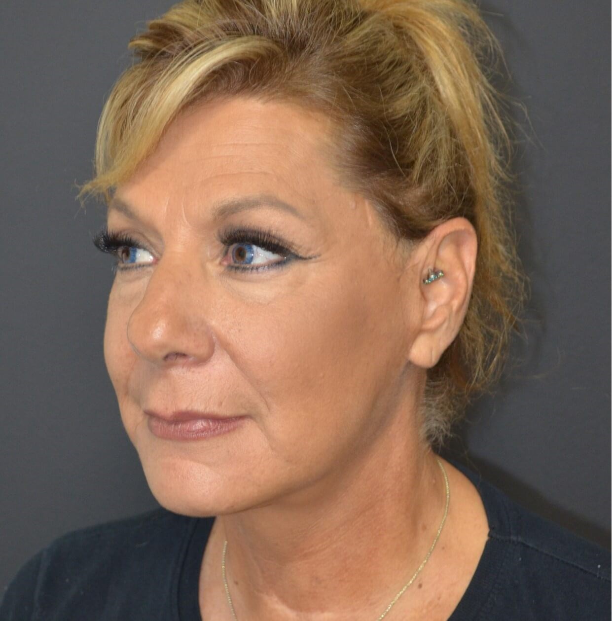 Deep plane face and necklift After