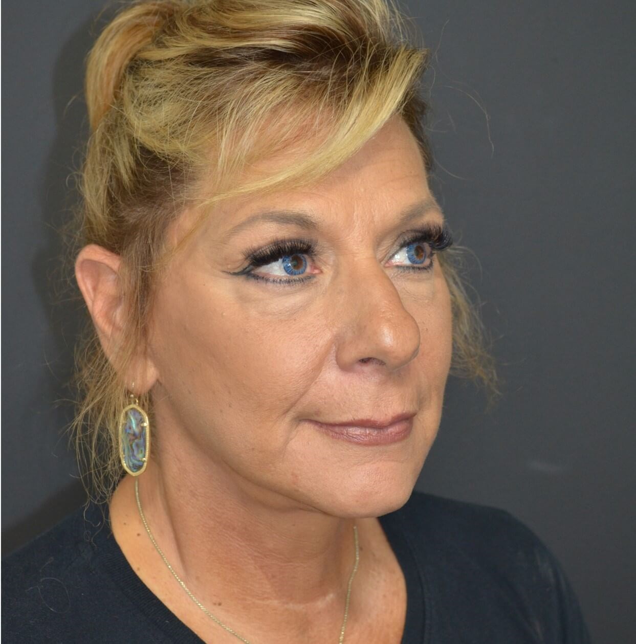 Deep plane face and necklift After