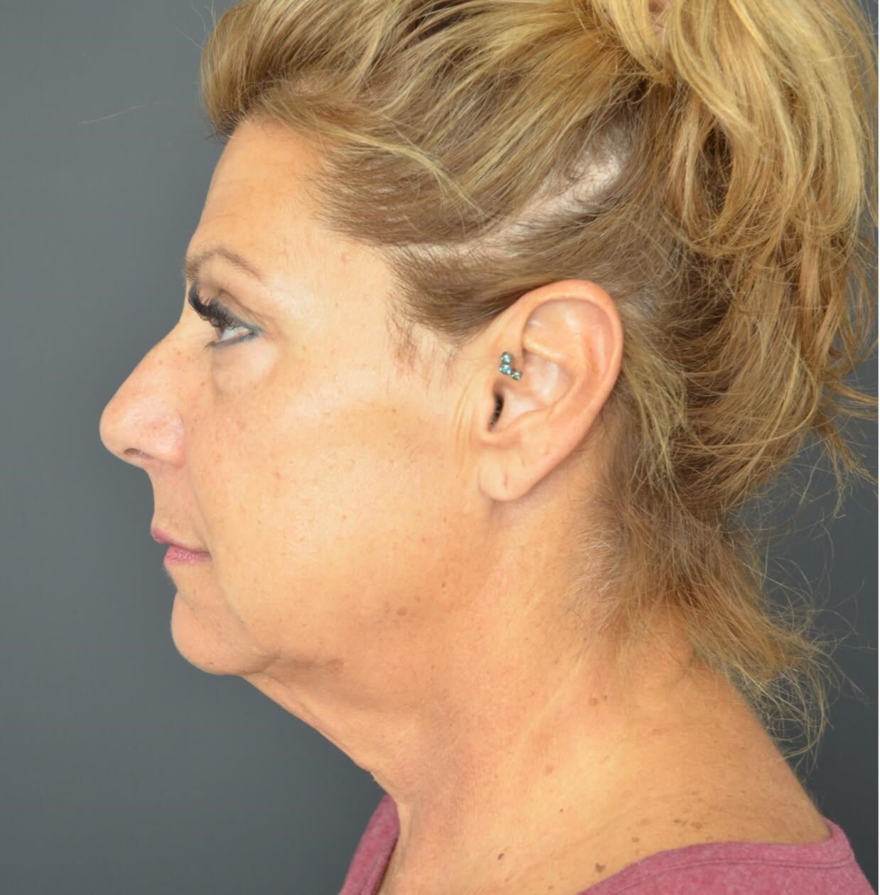Deep plane face and necklift Before