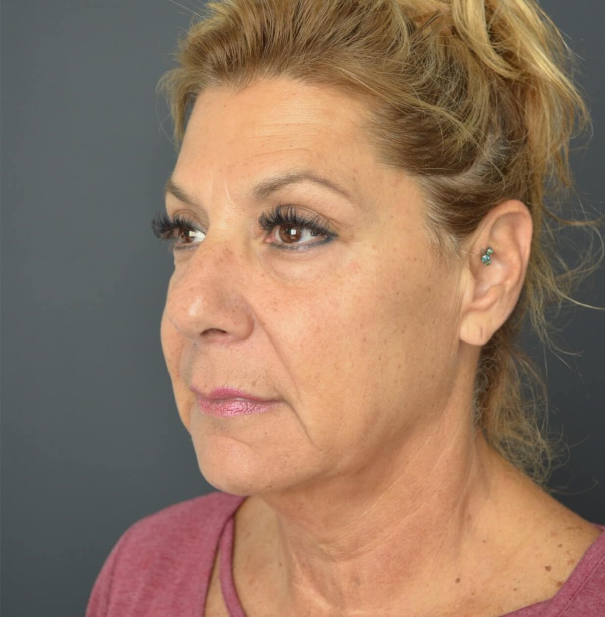 Deep plane face and necklift Before