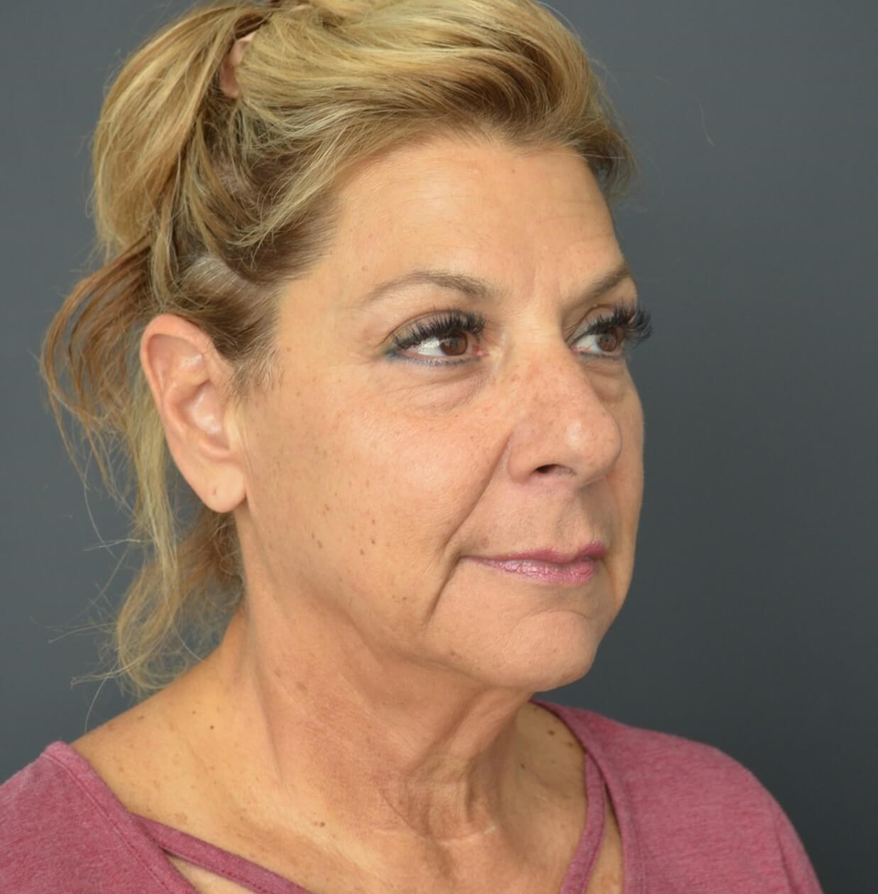 Deep plane face and necklift Before
