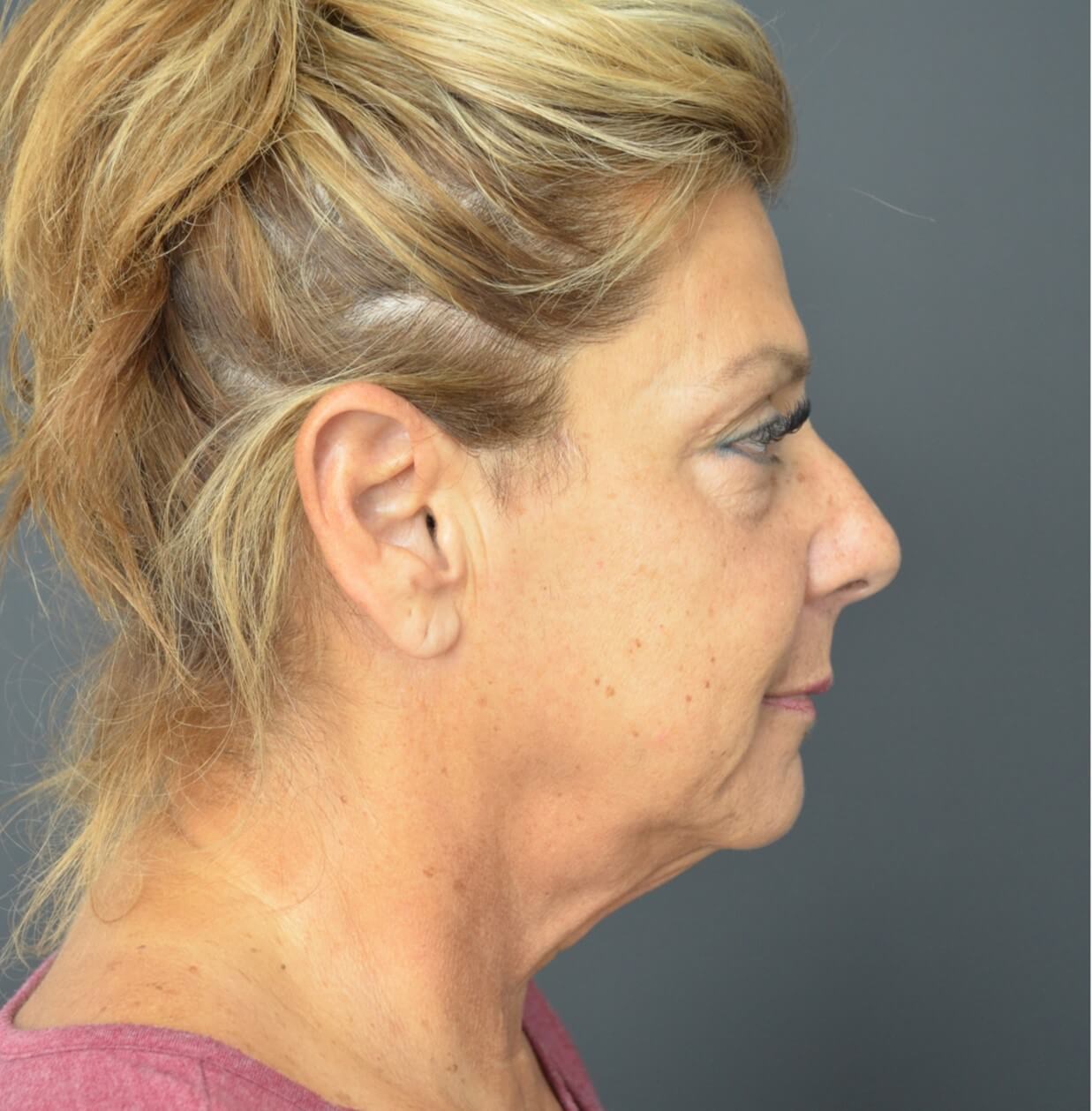 Deep plane face and necklift Before