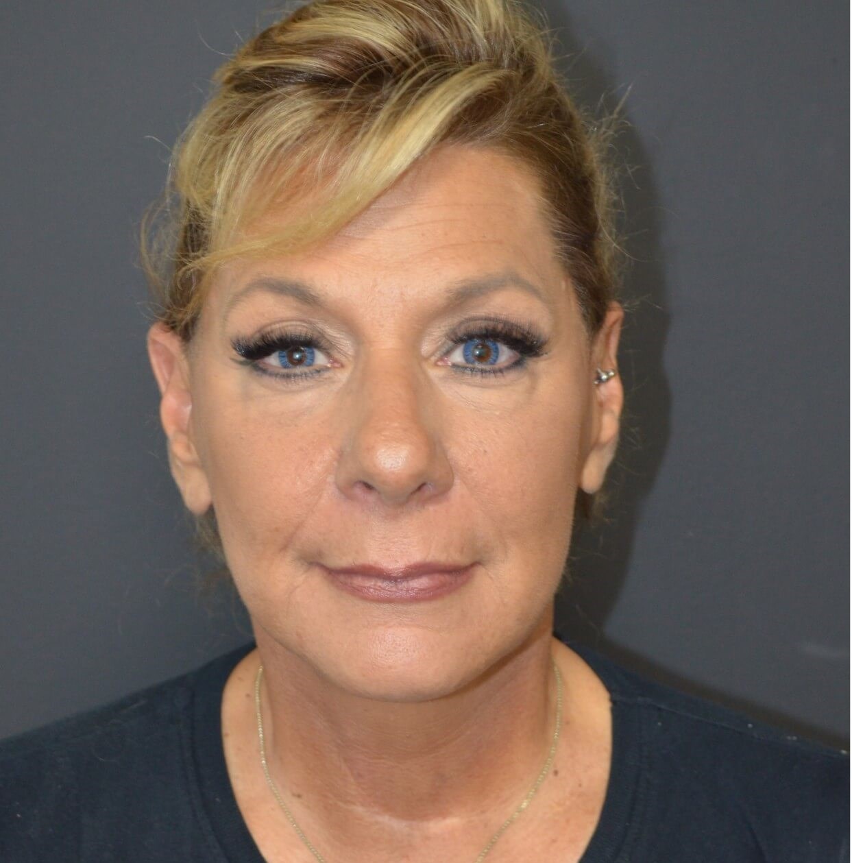 Deep plane face and necklift After