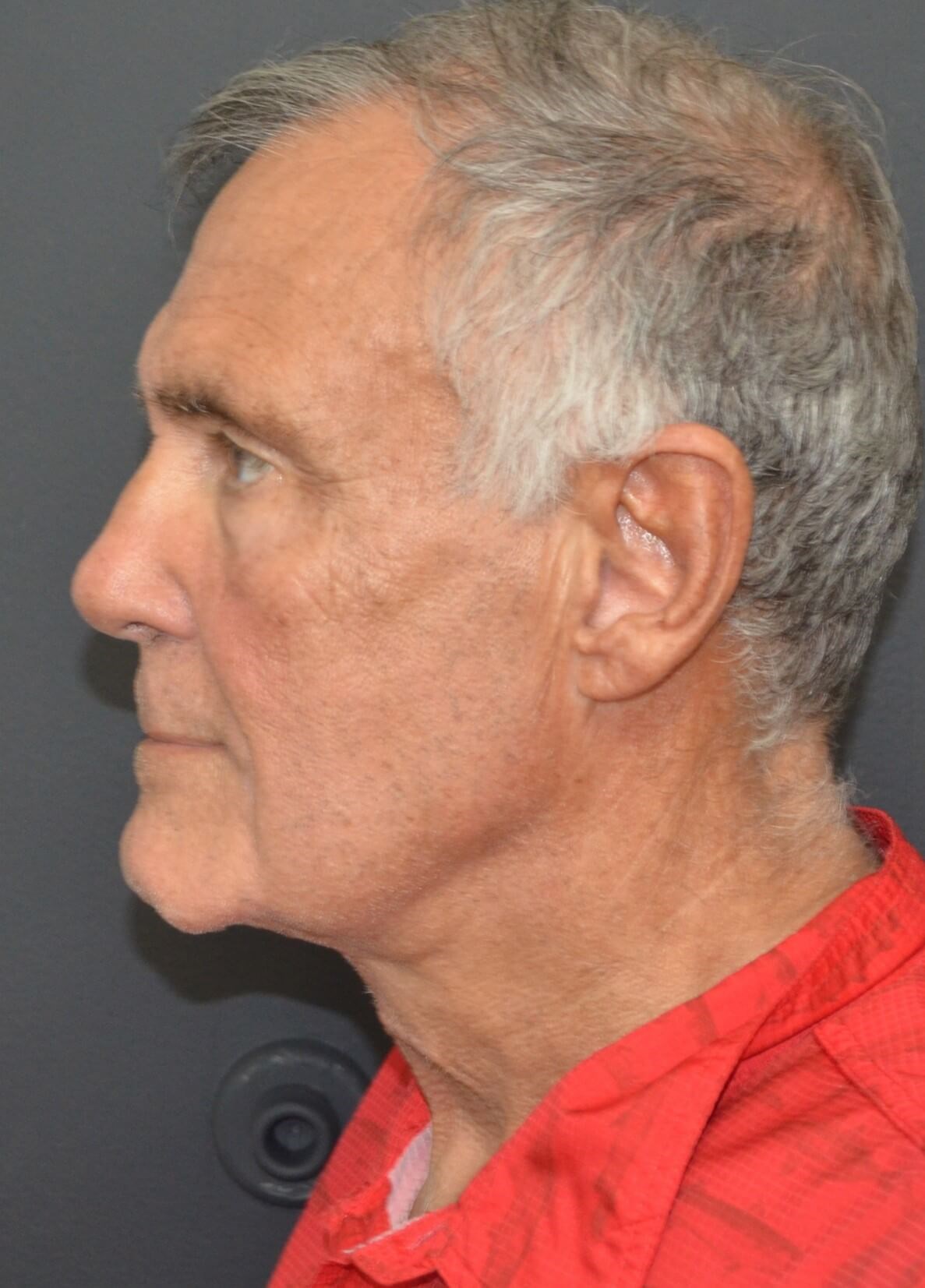 T-Z Necklift Local Anesthesia After