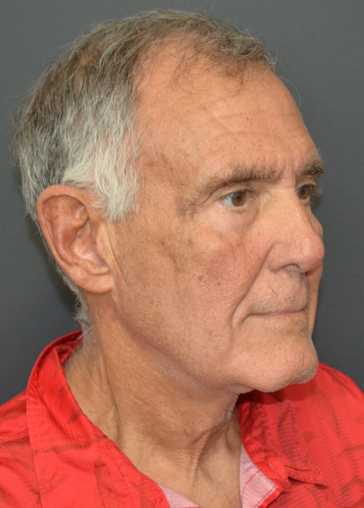 T-Z Necklift Local Anesthesia After