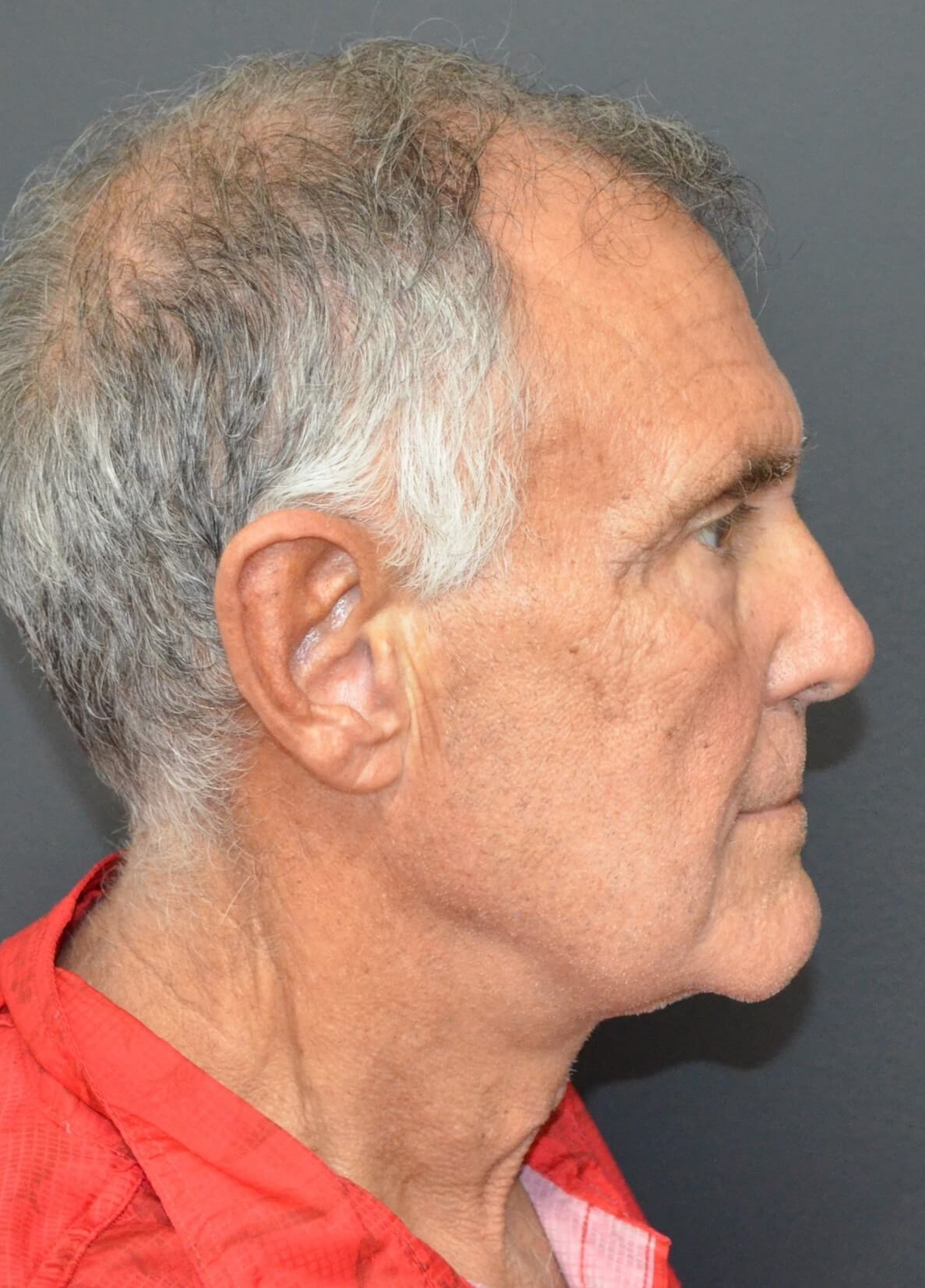 T-Z Necklift Local Anesthesia After