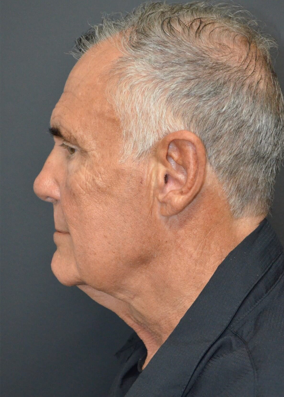 T-Z Necklift Local Anesthesia Before