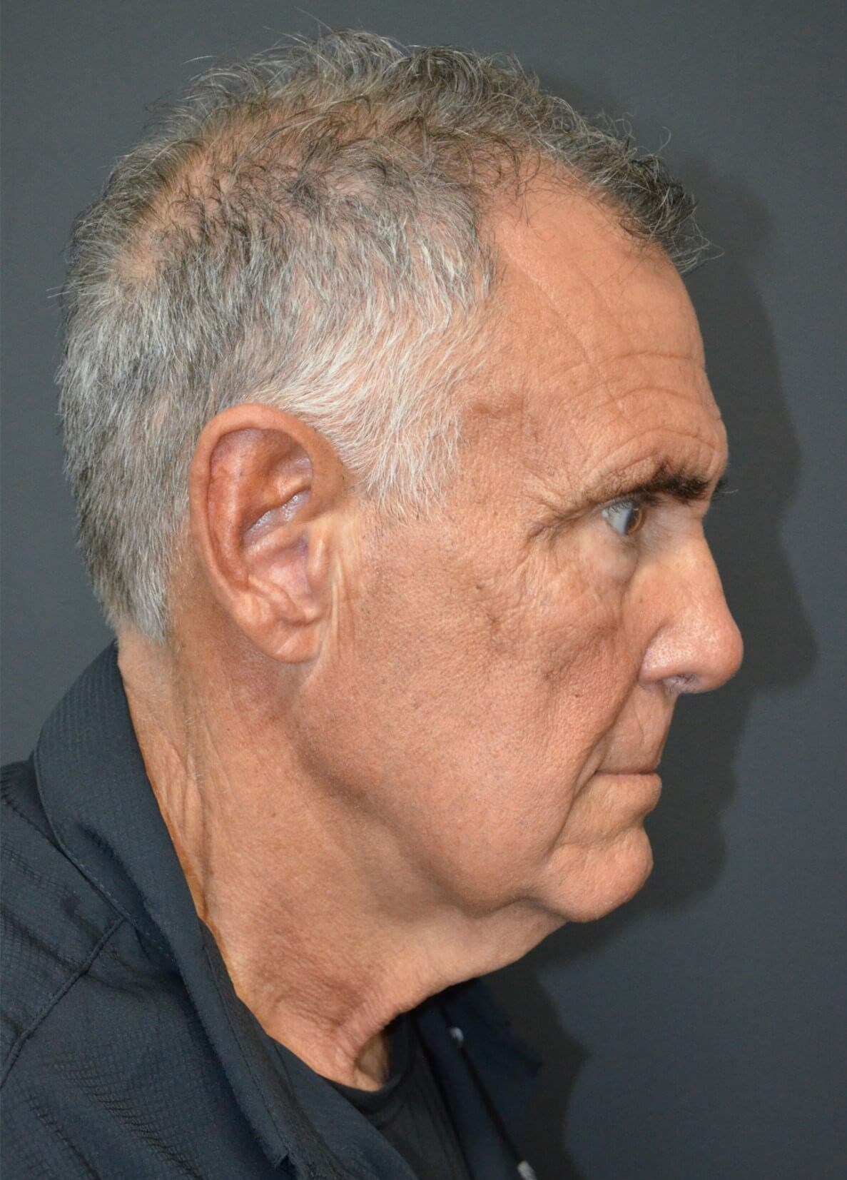 T-Z Necklift Local Anesthesia Before
