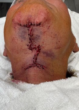 T-Z Necklift Local Anesthesia Before