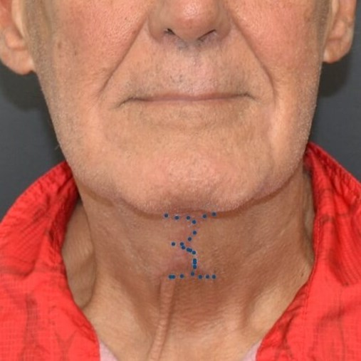 Incision Location of T-Z Neck 