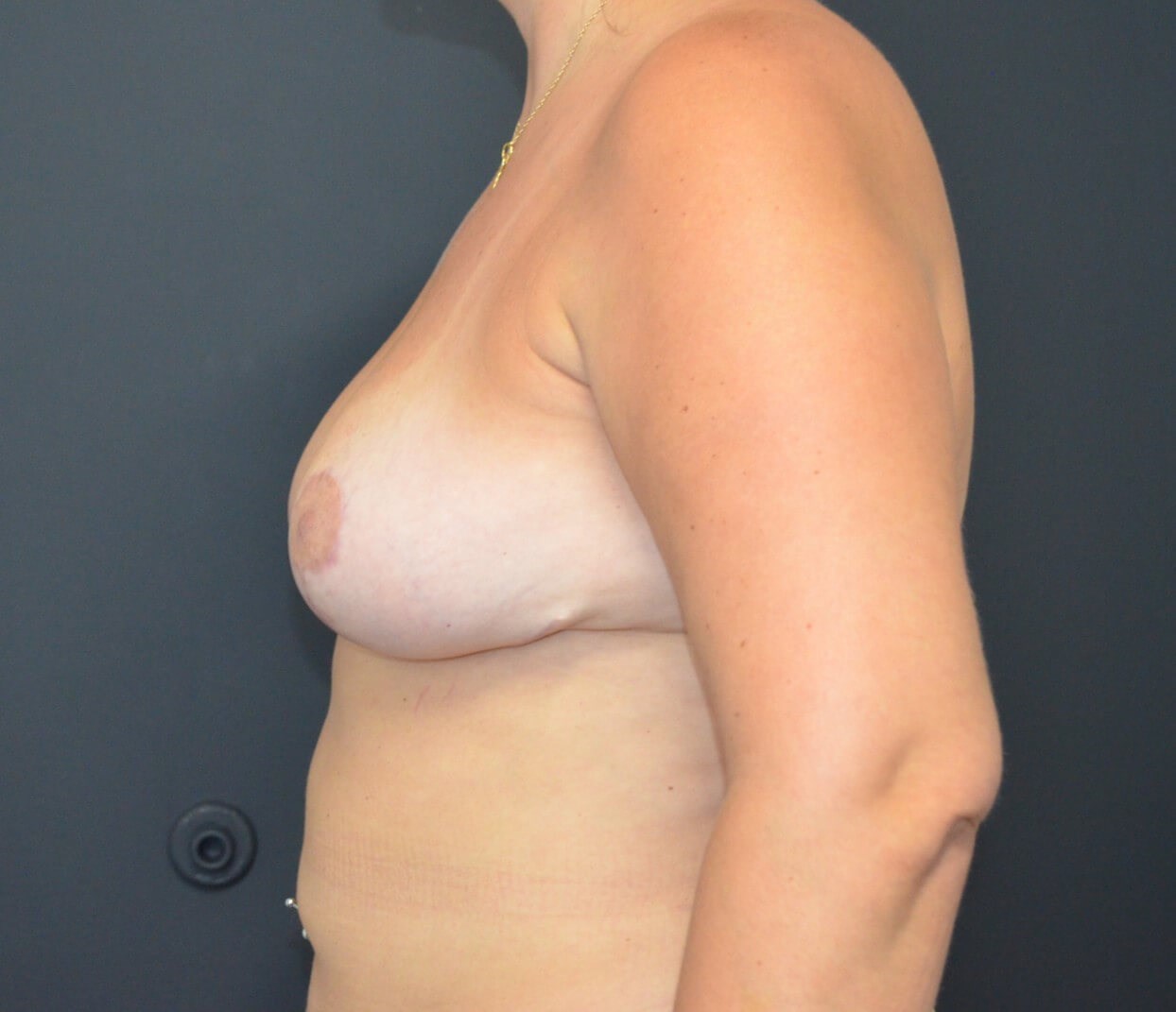 Breast Reduction Austin Texas After