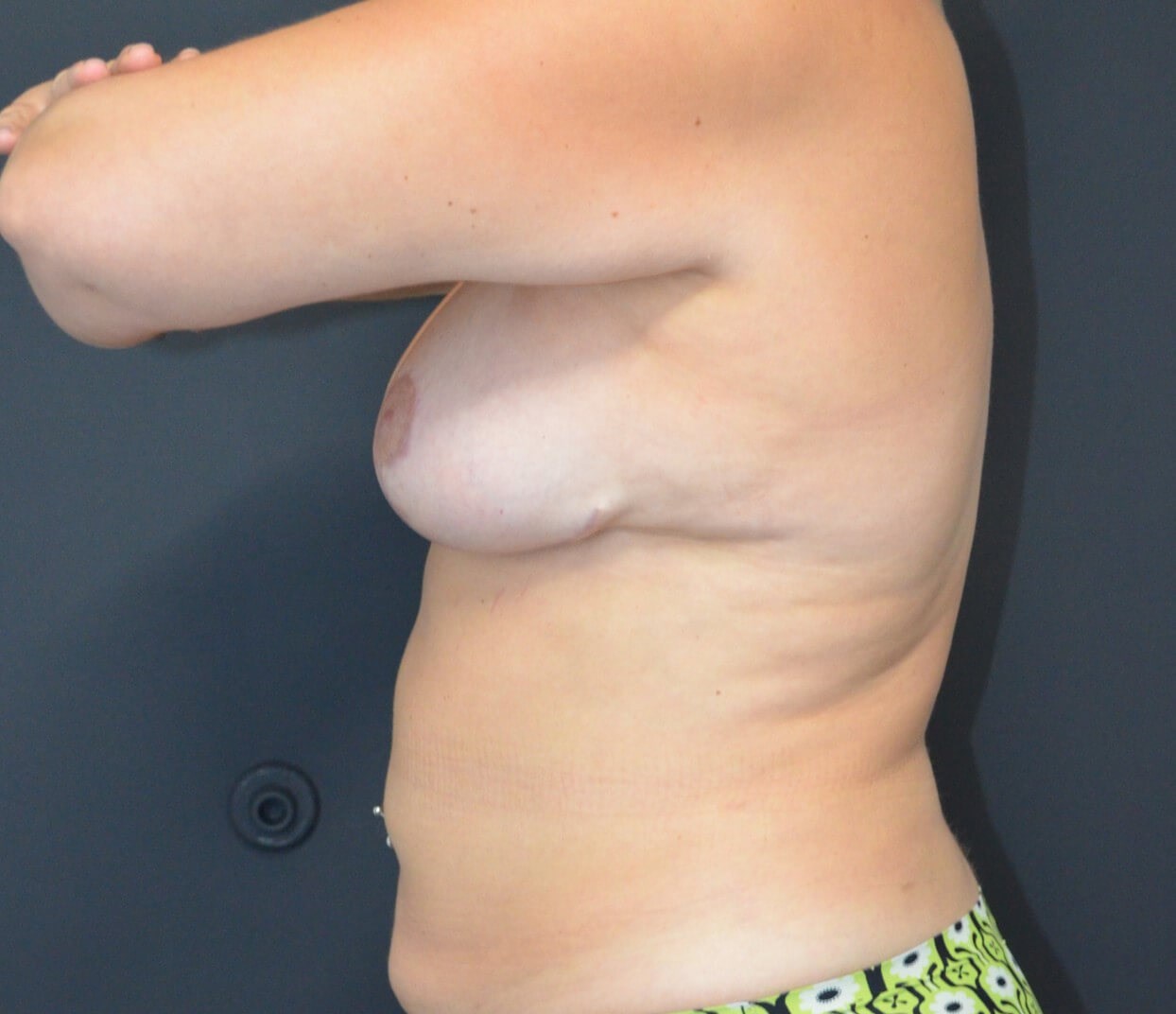 Vaser Lipo- arms, tummy chest After