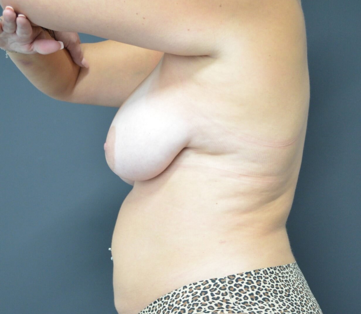 Vaser Lipo- arms, tummy chest Before