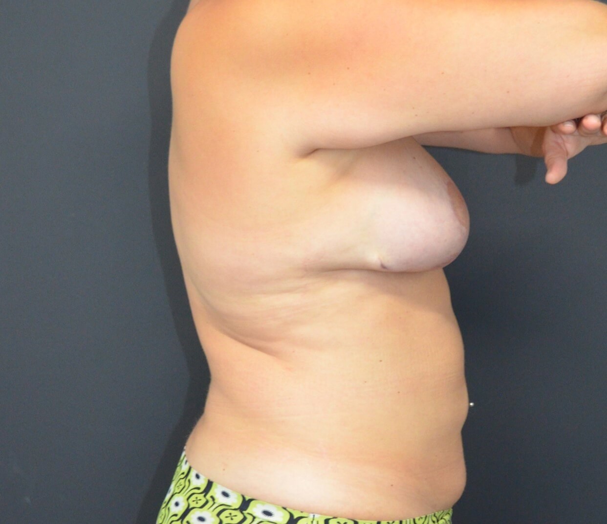 Vaser Lipo- arms, tummy chest After