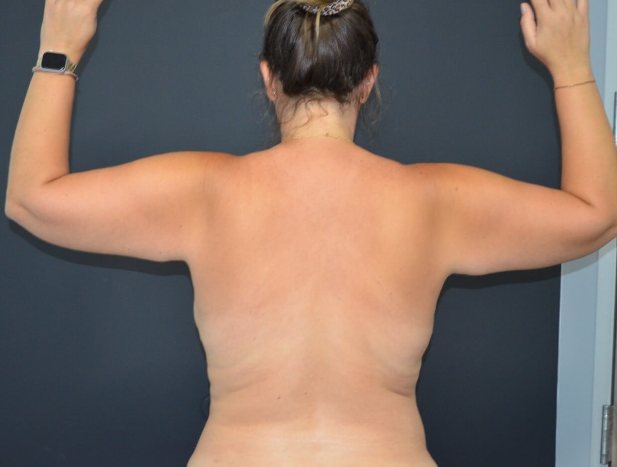 Vaser Lipo- arms, tummy chest After