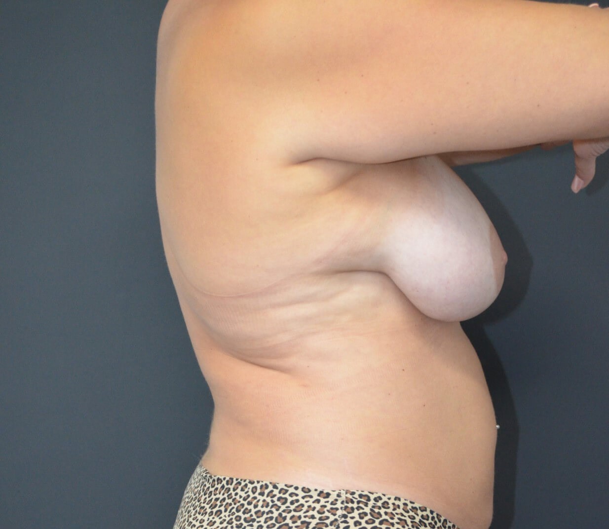 Vaser Lipo- arms, tummy chest Before